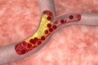 Cholesterol in artery Cholesterol in artery