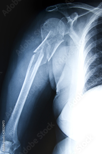 Photo: Humerus Fracture - Trauma Xray Humerus Fracture - Trauma Xray