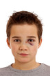Junge mit blauem Auge und gebrochener Nase