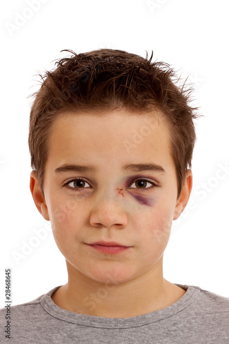 Photo: Junge mit blauem Auge und gebrochener Nase Junge mit blauem Auge und gebrochener Nase