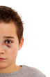 Junge mit blauem Auge und gebrochener Nase