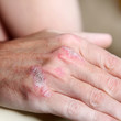 schuppenflechte am Handknochen schuppenflechte am Handknochen