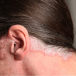 psoriasis - schuppenflechte im Ohr und am Nacken