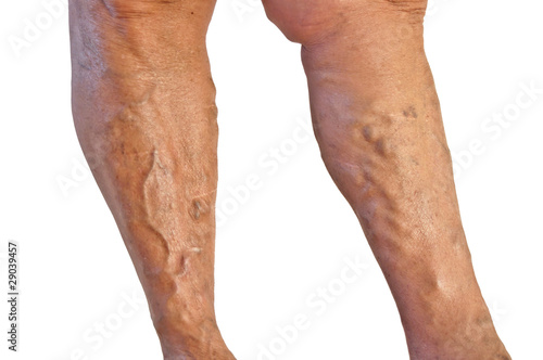 Photo: Varicose veins Varicose veins