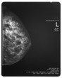 Healthy breast scan X-ray plate.