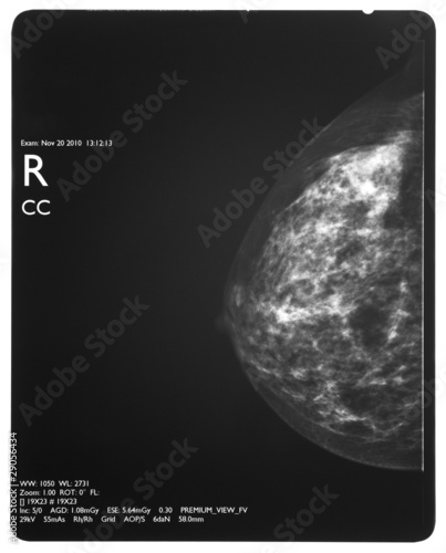 Photo: Healthy breast scan X-ray plate. Healthy breast scan X-ray plate.