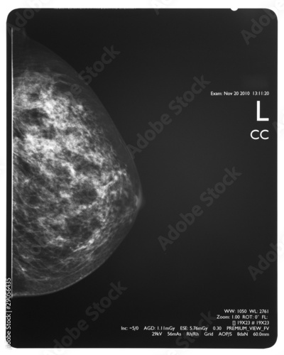 Photo: Healthy breast scan X-ray plate. Healthy breast scan X-ray plate.