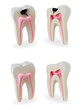 Sound teeth and teeth with caries in section