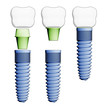 Photo: Dental implant. Elements view. Dental implant. Elements view.