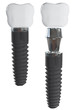 Illustration: Dental implant. Elements view. Dental implant. Elements view.