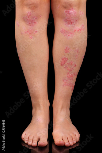 Photo: Psoriasis Psoriasis