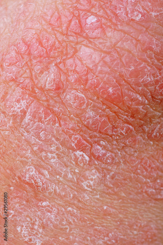 Photo: Psoriasis Psoriasis
