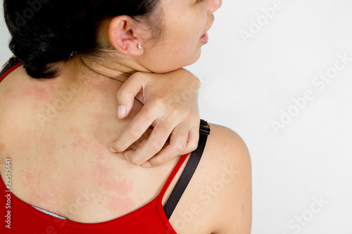 Photo: Ethic young woman back with itchy skin Ethic young woman back with itchy skin