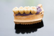 Dental bridge made of porcelain on casting