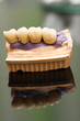 Dental bridge made of porcelain on casting