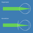 Schema Hyperopie mit Korrektion