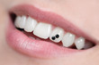 Photo: Close-up of open mouth with dental jewelry tooth Close-up of open mouth with dental jewelry tooth