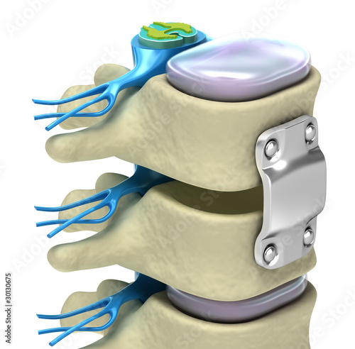 Illustration: Spinal fixation system - titanium bracket isolated on white Spinal fixation system - titanium bracket isolated on white
