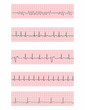 Cardiac dysrhythmia EKG flashcards