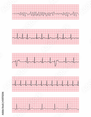 Vector: Cardiac dysrhythmia EKG flashcards Cardiac dysrhythmia EKG flashcards
