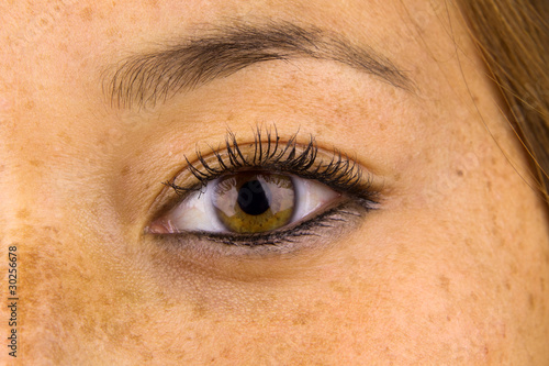Photo: Sun Damaged Skin Sun Damaged Skin