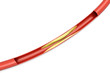 Arteriosklerose