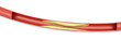 Arteriosklerose
