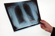 radio pulmonaire