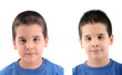 Photo: Before & After urticaria Before & After urticaria