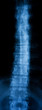 Spinal X-Ray Image Spinal X-Ray Image