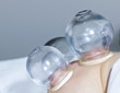 Cupping therapy in traditional chinese medicine Cupping therapy in traditional chinese medicine