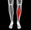 Illustration: broken leg under the X-rays broken leg under the X-rays