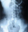 radiograph of human backbone