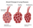 Lung diseases, eps8