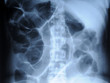 radiograph of human backbone