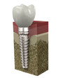Dental implant Dental implant