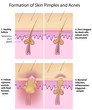 Formation of skin acnes and pimples, eps8