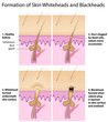 Formation of skin blackhead and whitehead, eps8