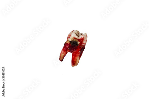 Photo: Decayed Molar Decayed Molar
