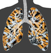 smoker's lung smoker's lung