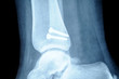 radiograph of human fracture fibula bone