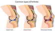 Common types of arthritis, eps8