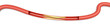 Arteriosklerose