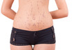 Closeup photo of a woman's abdomen marked with lines for surgery