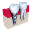 Dental implant - implanted in jaw bone. Isolated on white