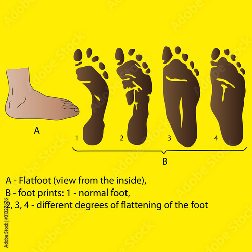 Vector: flatfoot flatfoot