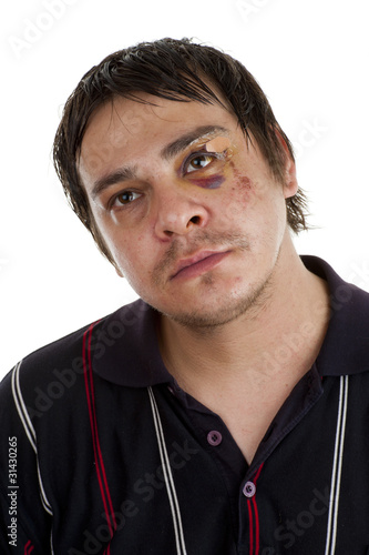 Photo: man with black eye man with black eye