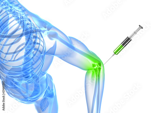 Illustration: 3d rendered illustration showing an elbow joint injection 3d rendered illustration showing an elbow joint injection