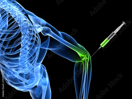 Illustration: 3d rendered illustration showing an elbow joint injection 3d rendered illustration showing an elbow joint injection