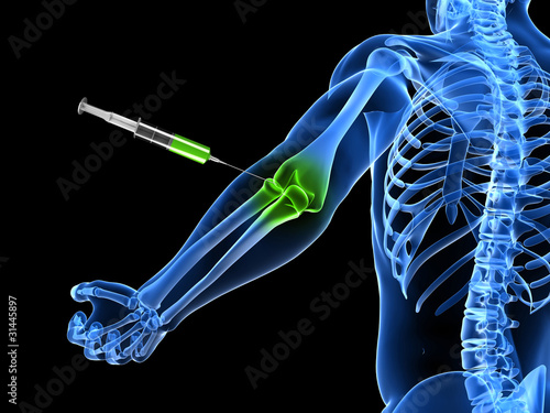 Illustration: 3d rendered illustration showing an elbow joint injection 3d rendered illustration showing an elbow joint injection